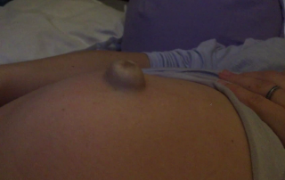 Pregnant Woman Experiences Umbilical hernia