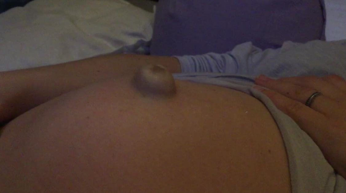 Pregnant Woman Experiences Umbilical hernia