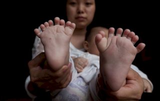 A baby boy Born With 31 Toes And Fingers Has A Genetic Condition Inherited From Mother