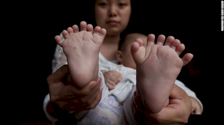 A baby boy Born With 31 Toes And Fingers Has A Genetic Condition Inherited From Mother