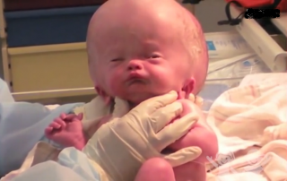 Unbelievable Miracle Happened To A Boy Born With Huge Swollen Head